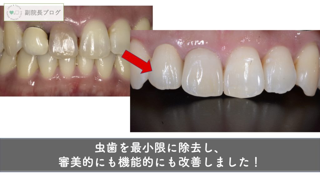 変色した前歯をセラミックにし 見た目を改善しました 岩手県盛岡市の歯医者 都南歯科医院