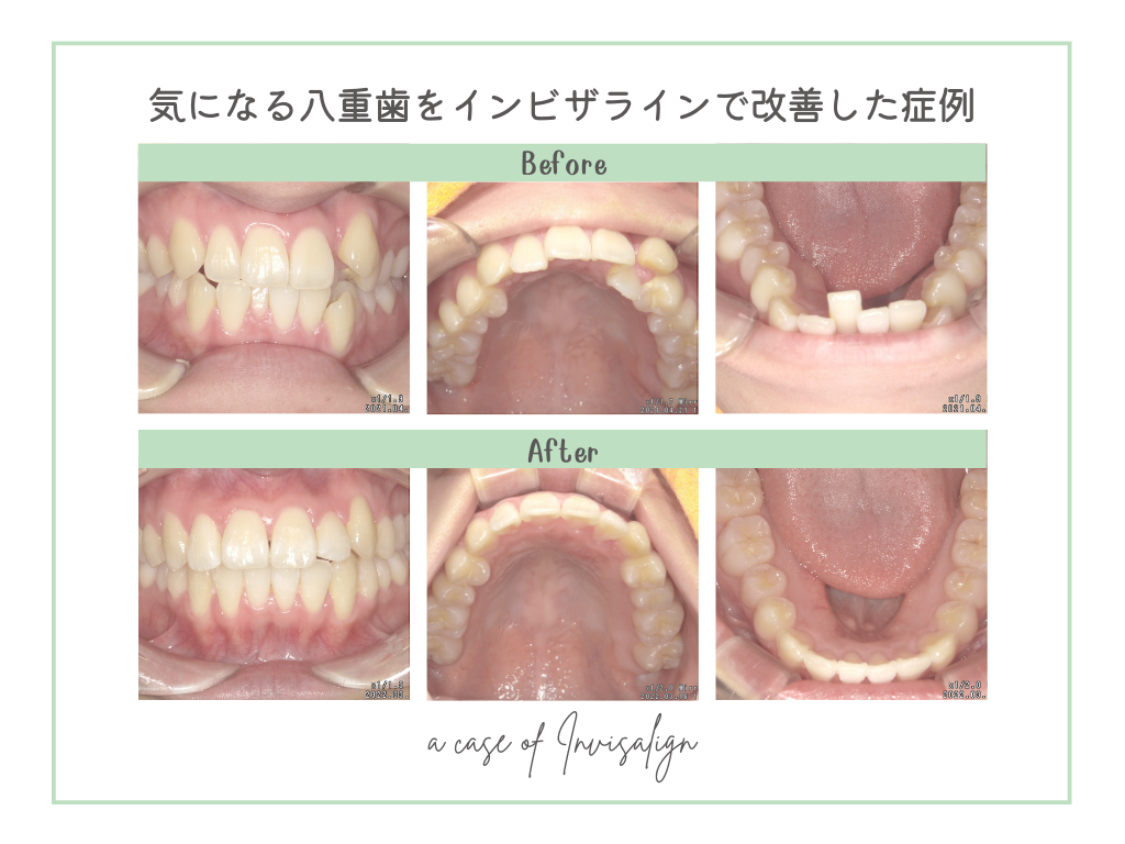気になる八重歯をインビザライン マウスピース矯正 で改善した症例 岩手県盛岡市の歯医者 盛岡となん歯科 こども矯正歯科
